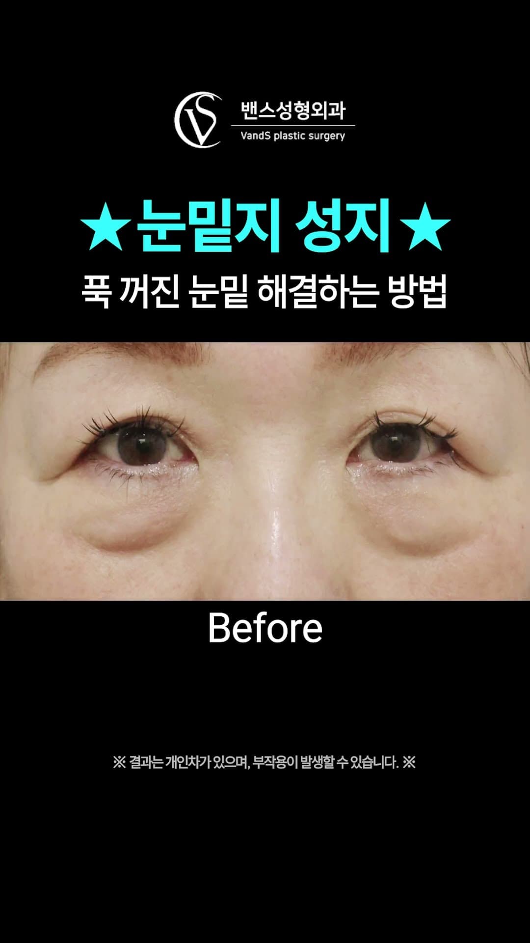 도이준TV — 푹 꺼진 눈밑, 눈밑지방재배치로 달라질까?