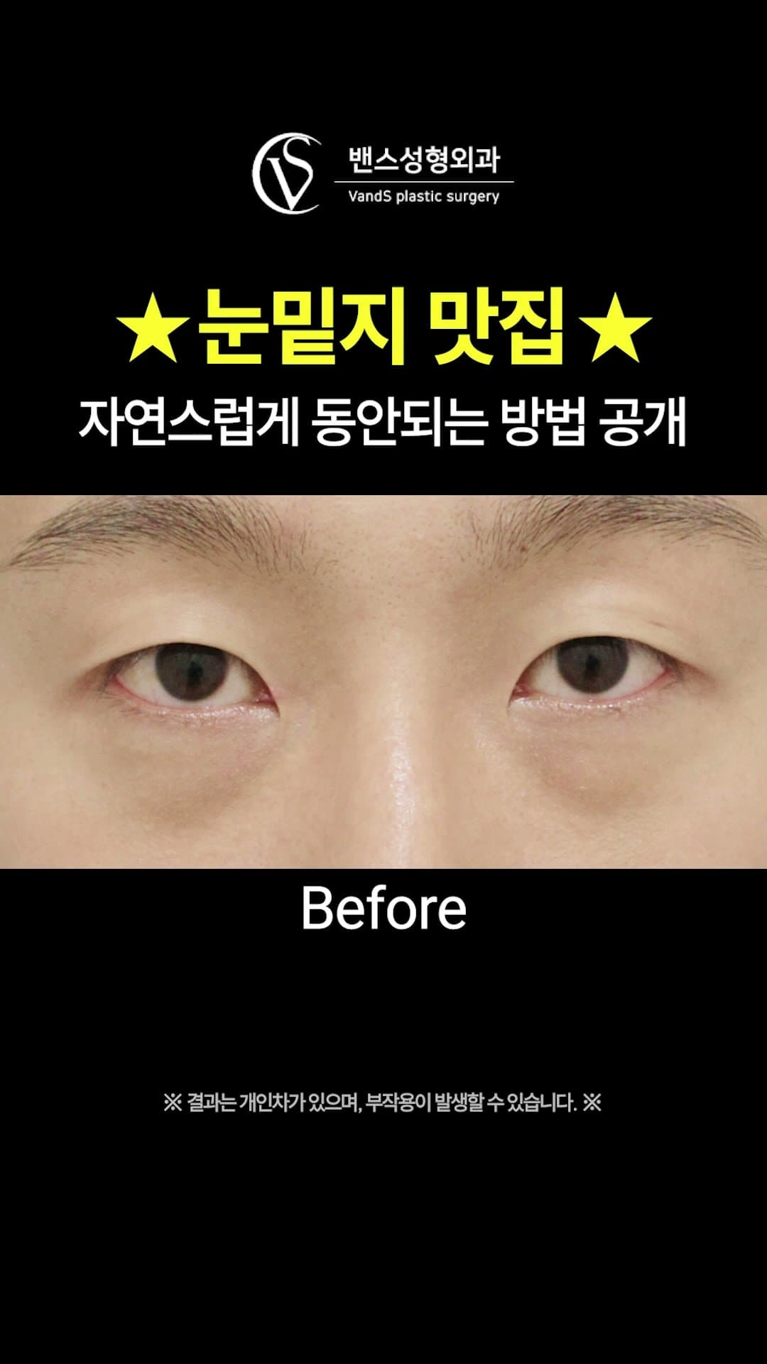 도이준TV — 눈밑지방재배치, 실제 케이스 모음