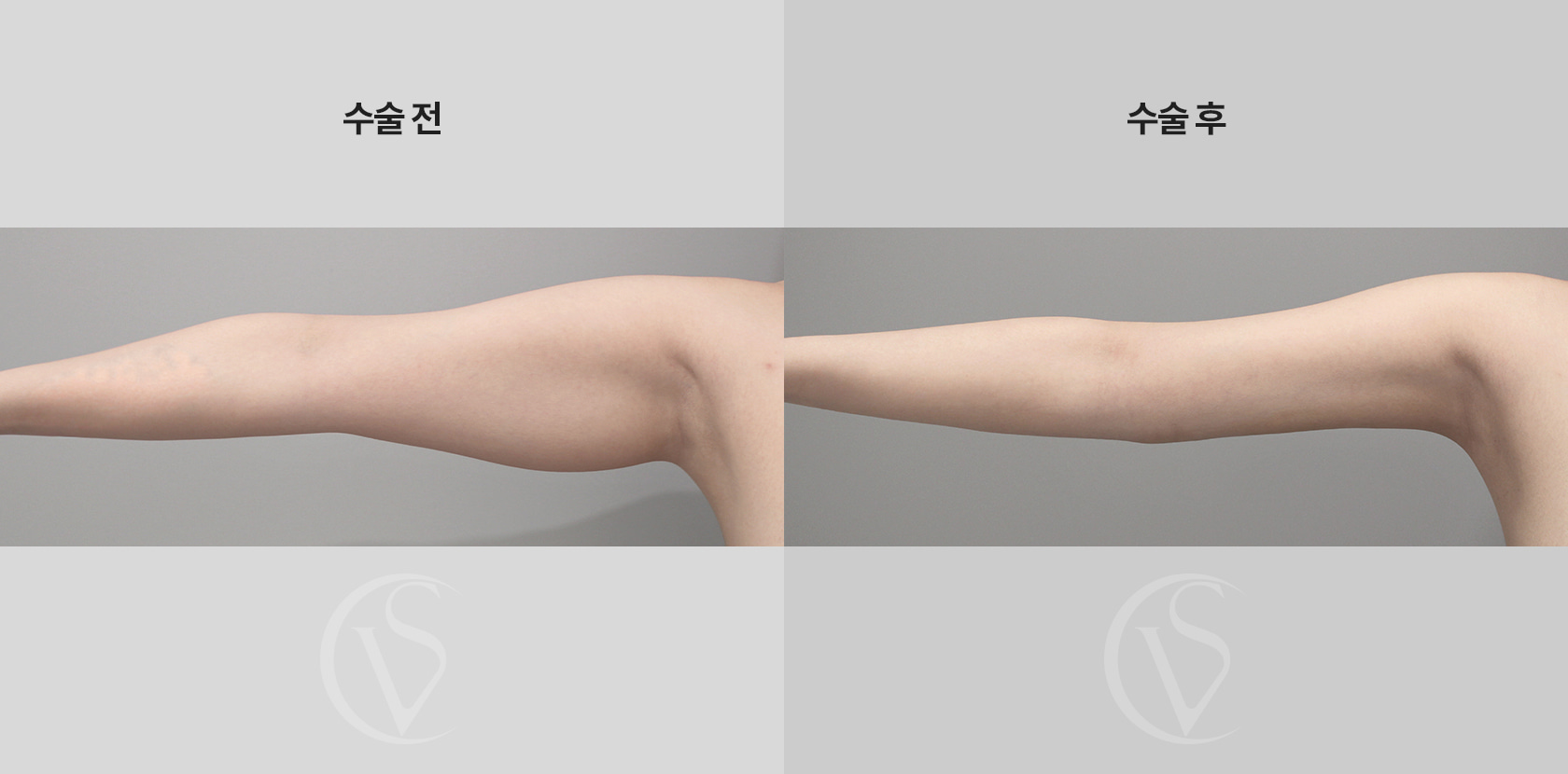 팔뚝 전체 지방흡입 전후 비교 사진
