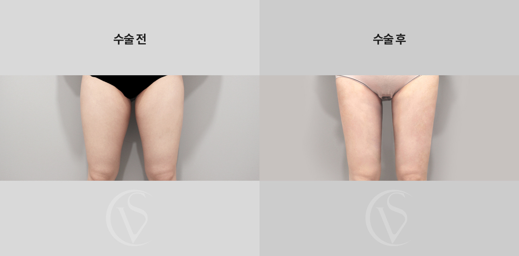 허벅지 전체 지방흡입 전후 비교 사진