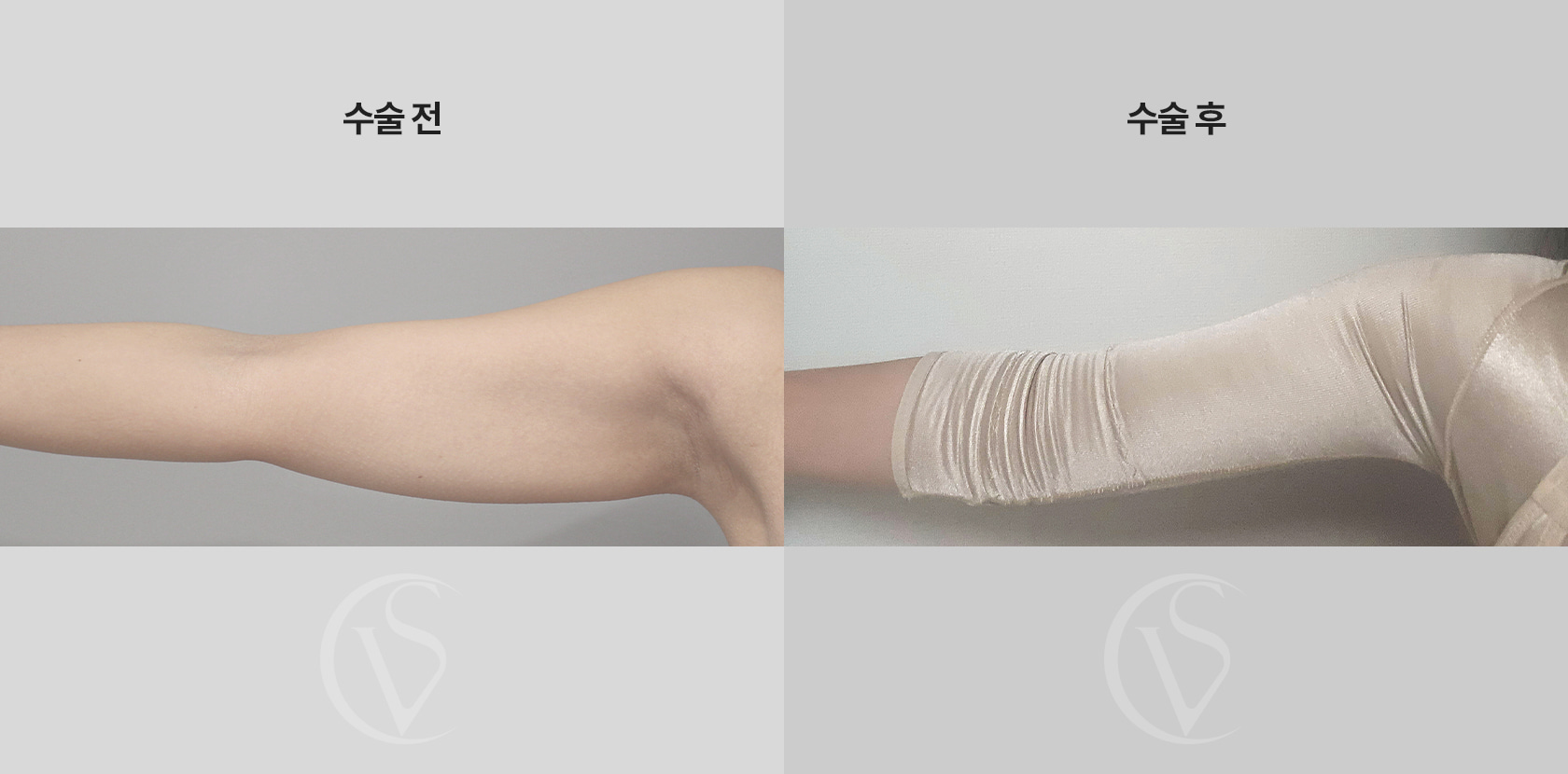 팔뚝 전체 지방흡입 전후 비교 사진