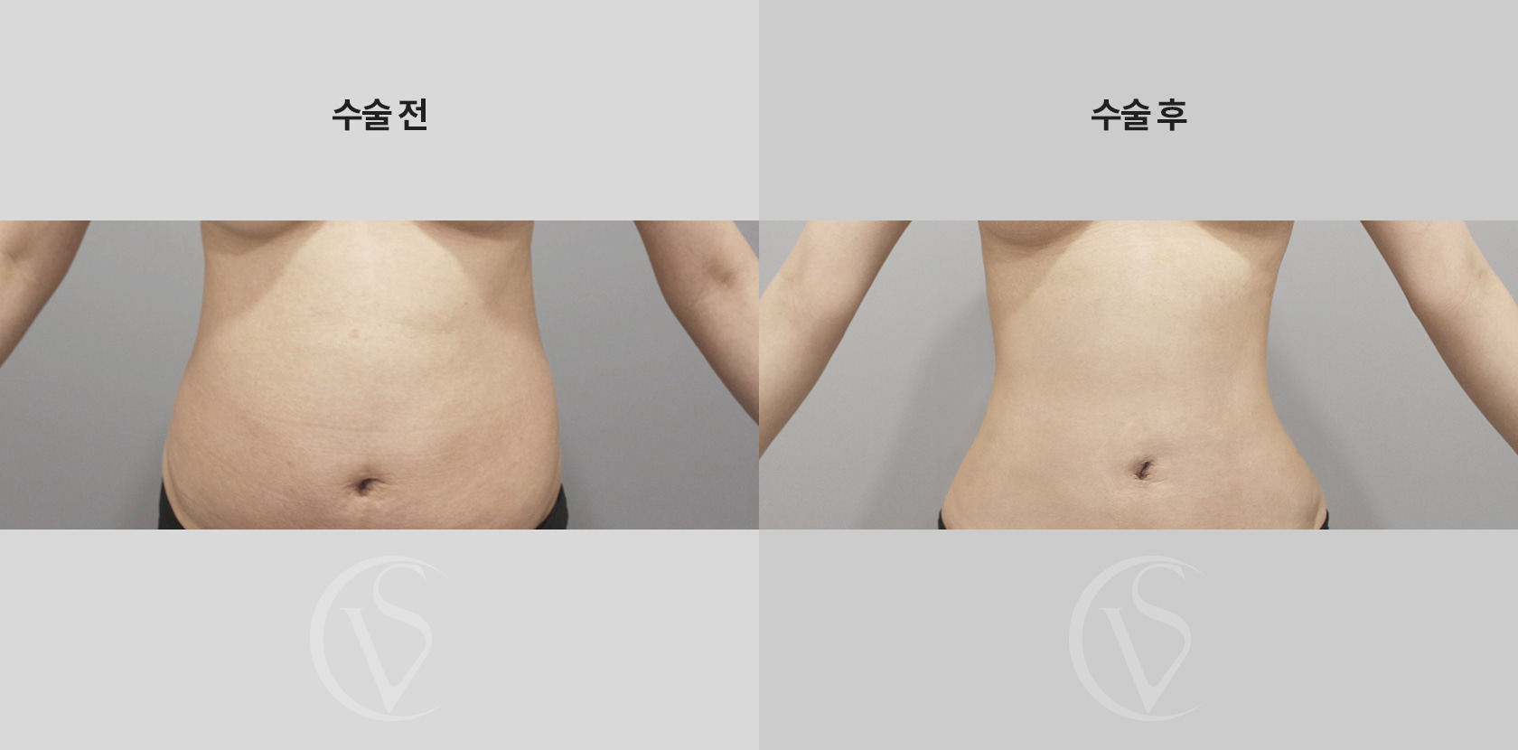 복부 전체 지방흡입 전후 비교 사진