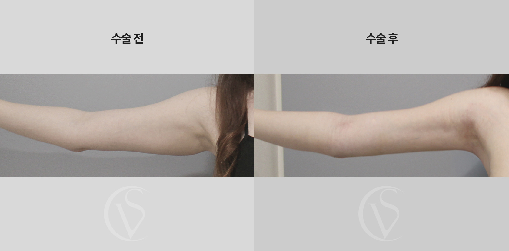 팔뚝 전체 지방흡입 전후 비교 사진