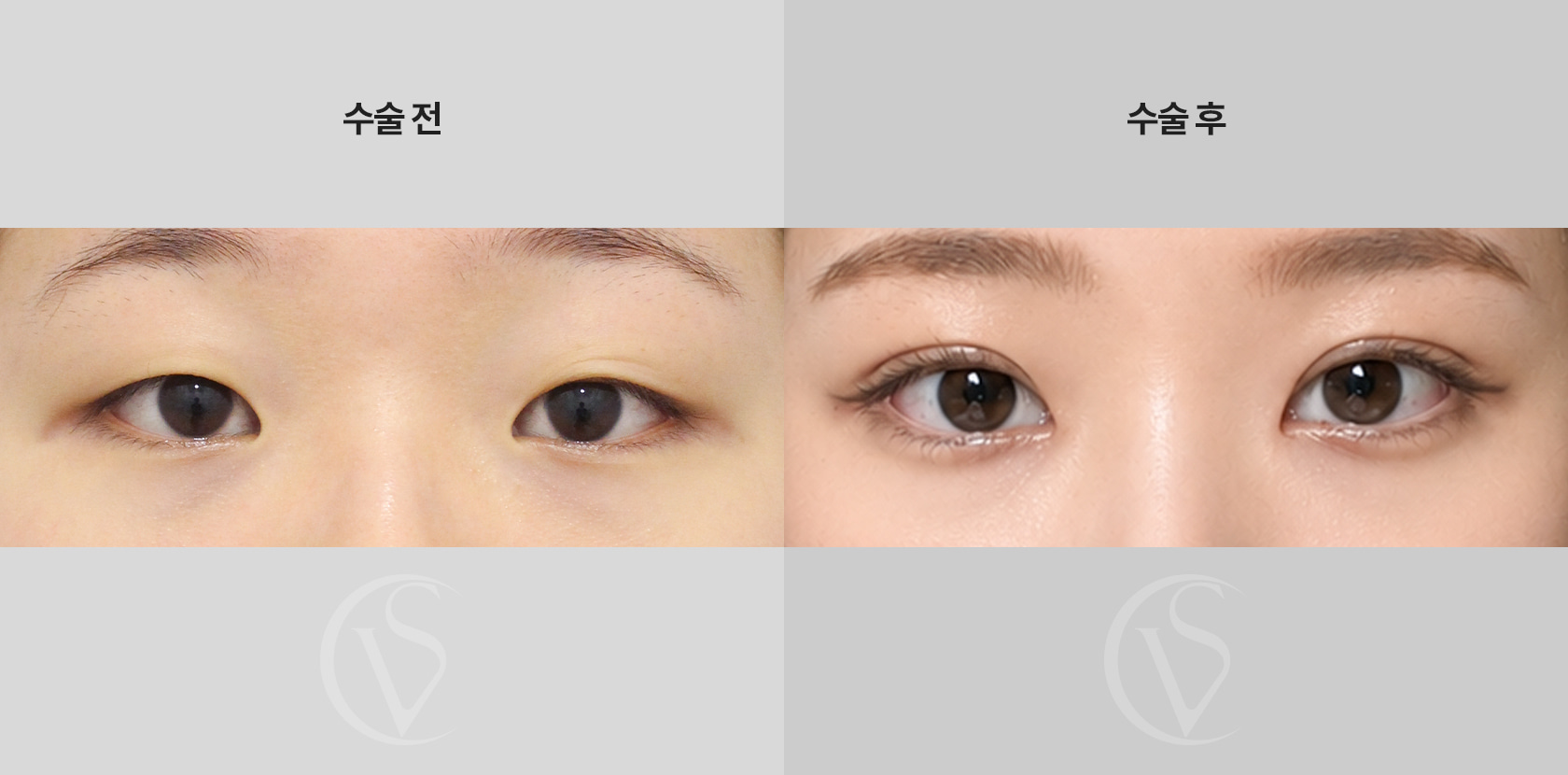 절개쌍꺼풀,눈매교정,앞트임 전후 비교 사진