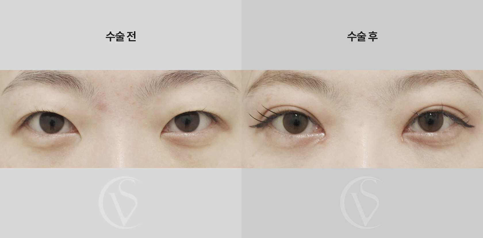 자연유착, 앞트임 전후 비교 사진